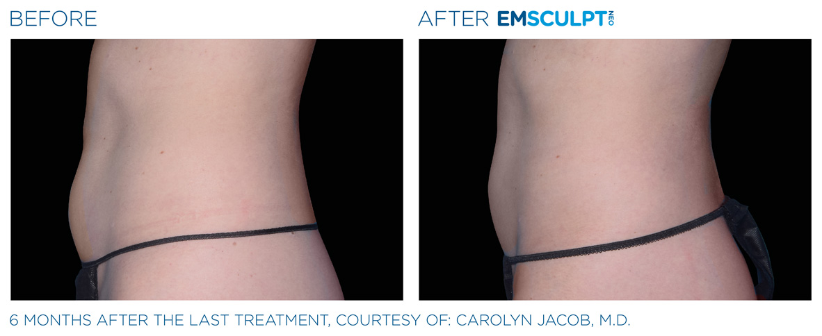 EMSCULPT NEO Before and After