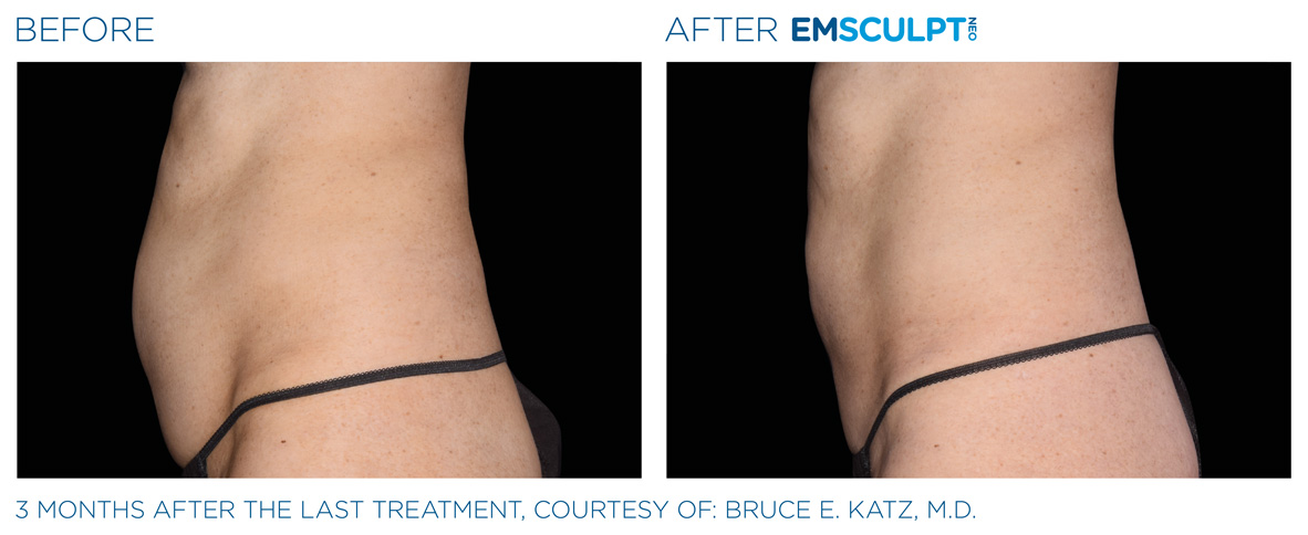 EMSCULPT NEO Before and After