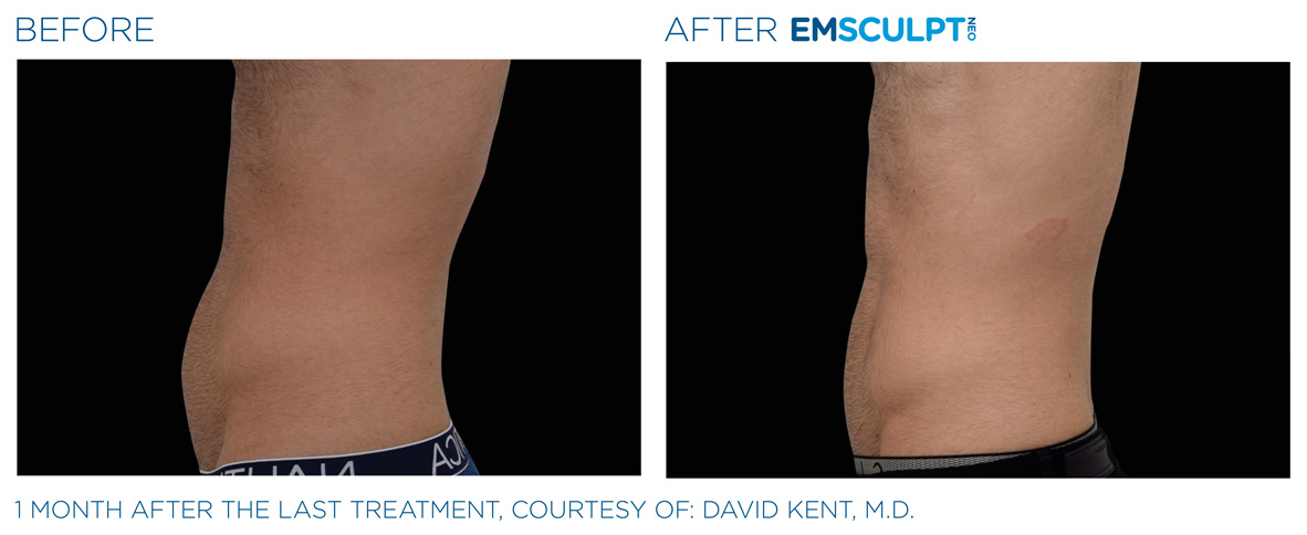 EMSCULPT NEO Before and After