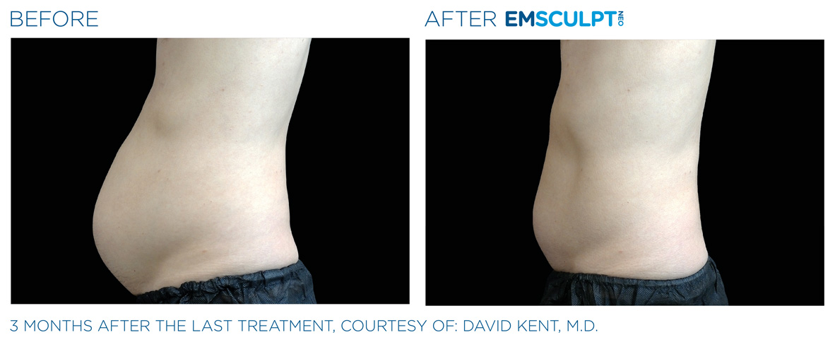 EMSCULPT NEO Before and After